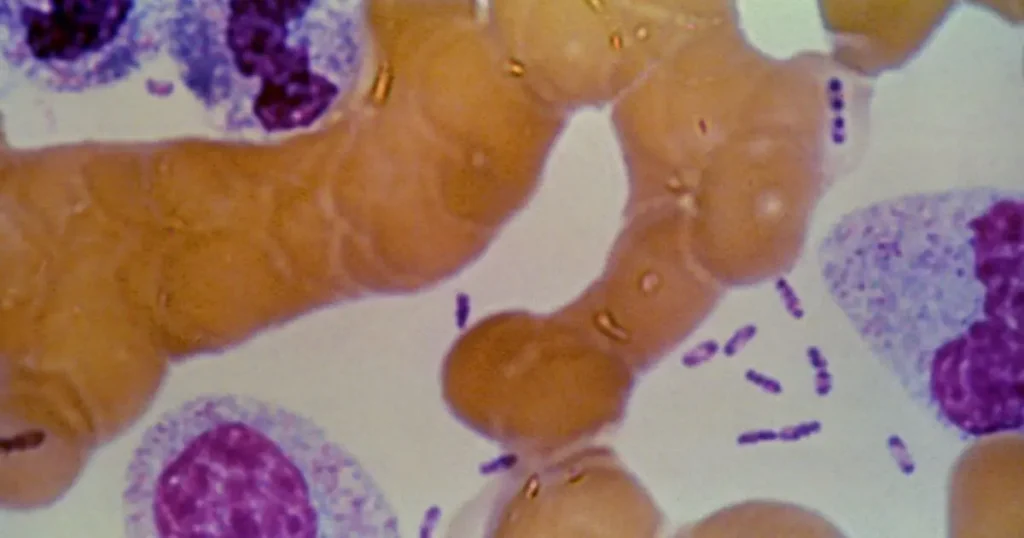 This image appears to be a microscopic view of blood cells, possibly stained for medical analysis, showing various types of cells and possibly bacteria.